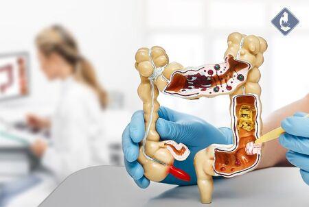 „ЛИНА” предлага ColoTect 3.0 – неинвазивен тест за ранно откриване на колоректален карцином „ЛИНА”-предлага-colotect-3.0-–-неинвазивен-тест-за-ранно-откриване-на-колоректален-карцином